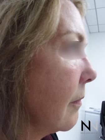 Laser Skin Resurfacing - Face: Patient 1 - After Image 1