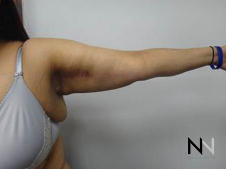 Brachioplasty: Patient 3 - After Image 1