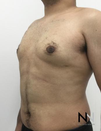 Gynecomastia: Patient 10 - After Image 5