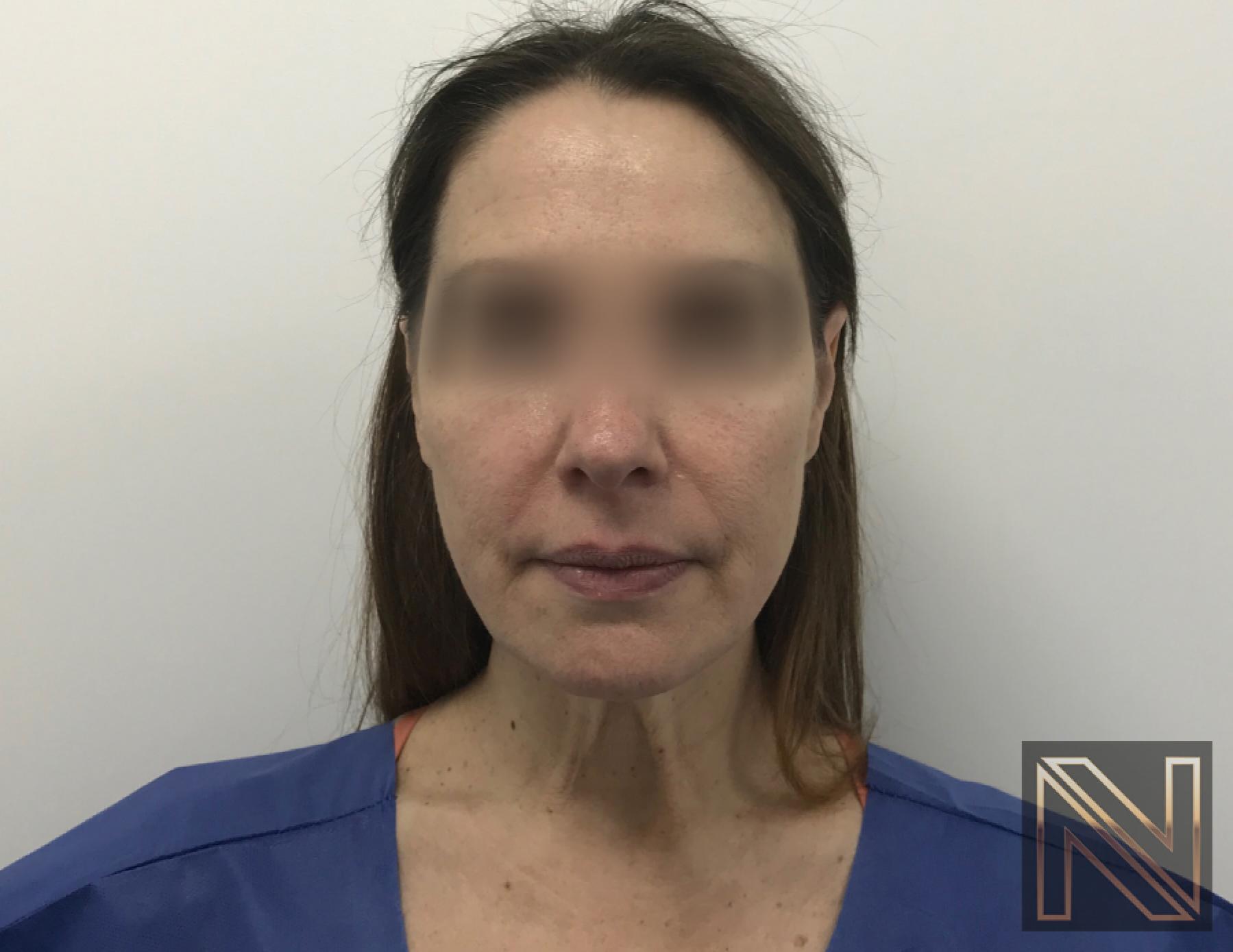 Facelift/Mini Facelift: Patient 5 - Before and After 3