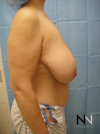 Breast Reduction: Patient 8 - Before and After Image 5