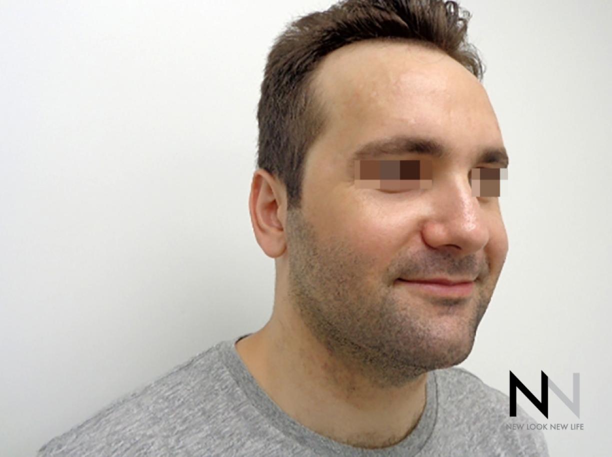 Laser Skin Resurfacing - Face: Patient 3 - After 3