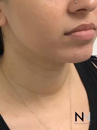 Liposuction: Patient 2 - After Image 2