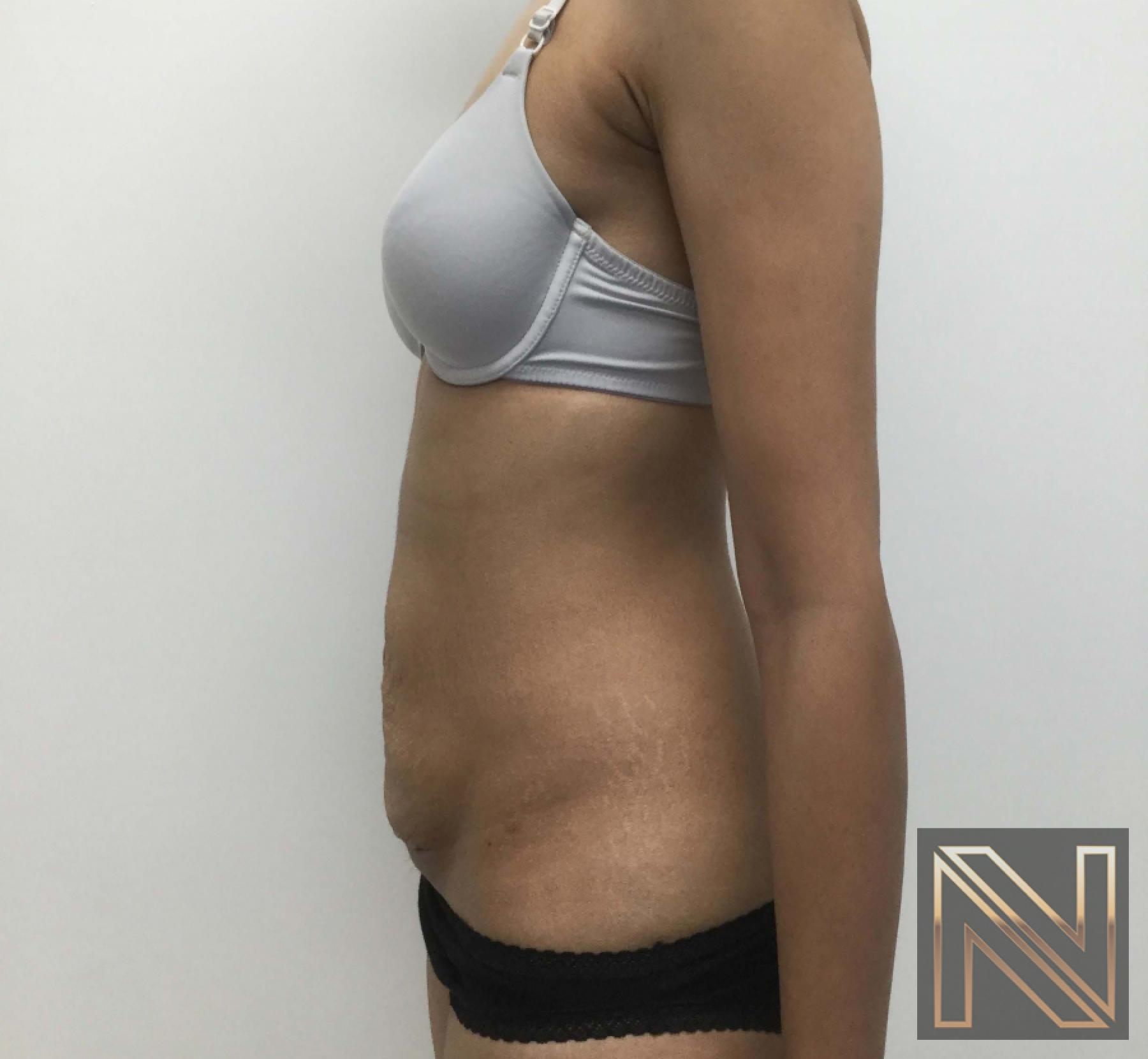 Abdominoplasty: Patient 29 - Before and After 3