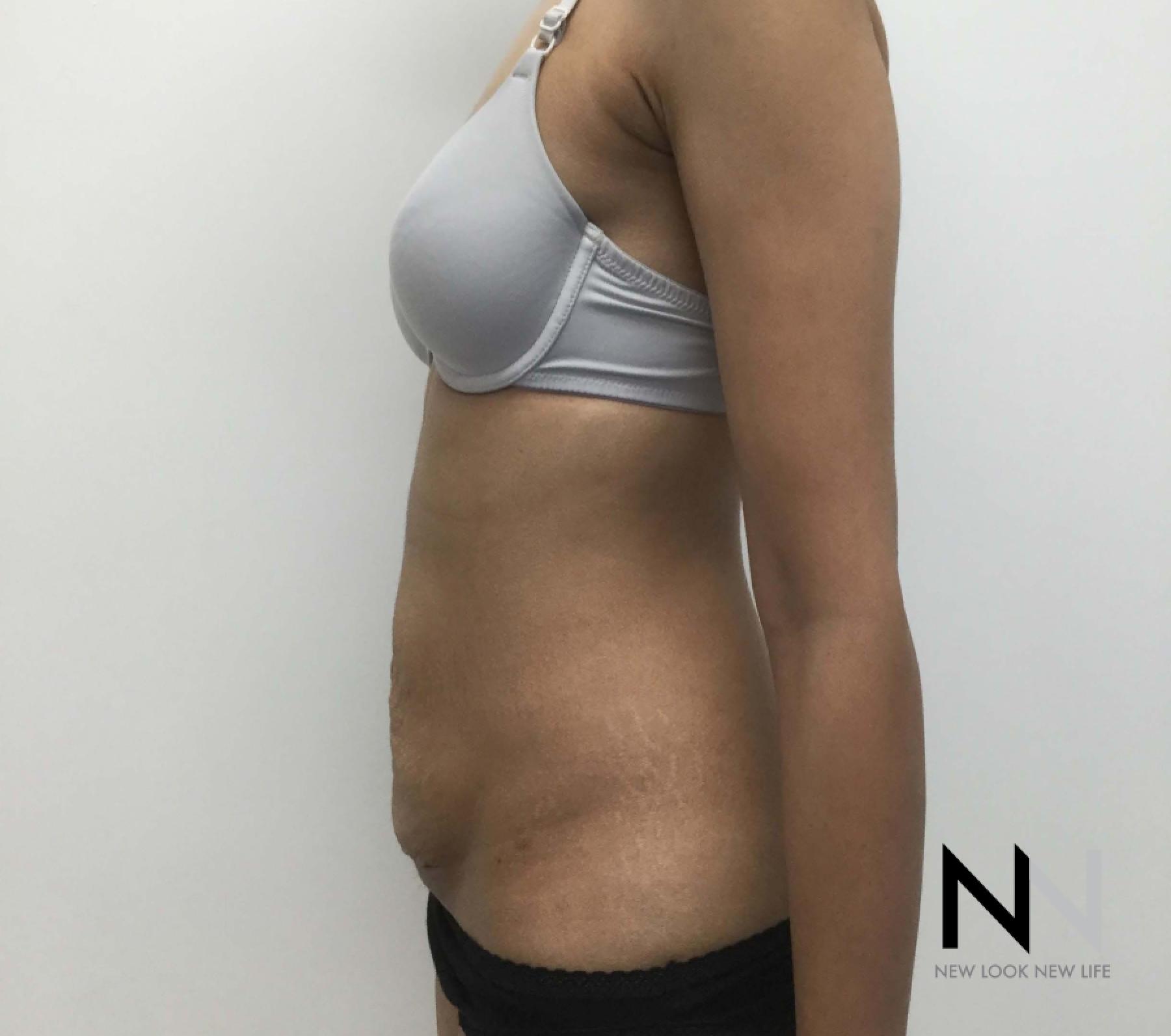 Abdominoplasty: Patient 29 - Before and After 3