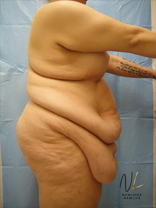 Abdominoplasty: Patient 16 - Before and After 3