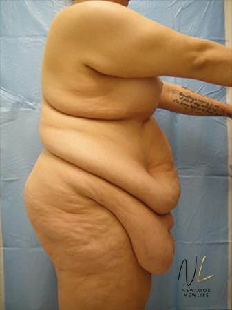 Abdominoplasty: Patient 16 - Before and After Image 3