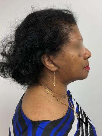 Facelift/Mini Facelift: Patient 7 - After Image 2