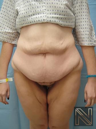 Abdominoplasty: Patient 2 - Before 
