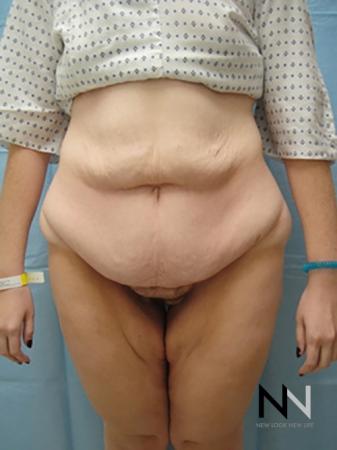 Abdominoplasty: Patient 2 - Before Image 1
