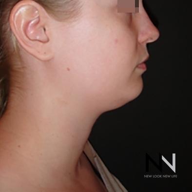 Liposuction: Patient 1 - Before and After Image 5