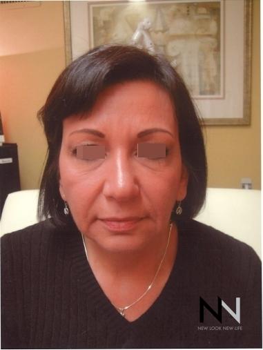 Liquid Facelift: Patient 5 - After  