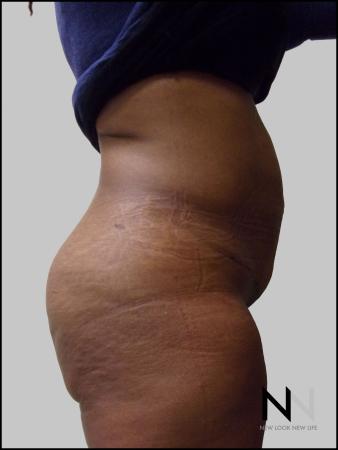 Mini Tummy Tuck: Patient 3 - After Image 2