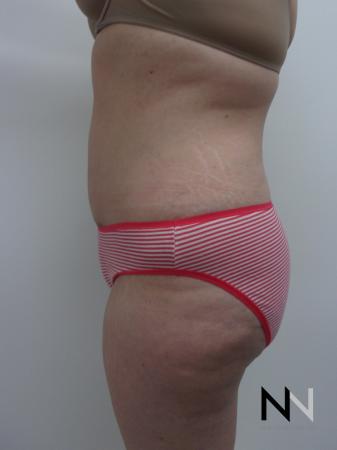 Abdominoplasty: Patient 21 - After Image 3