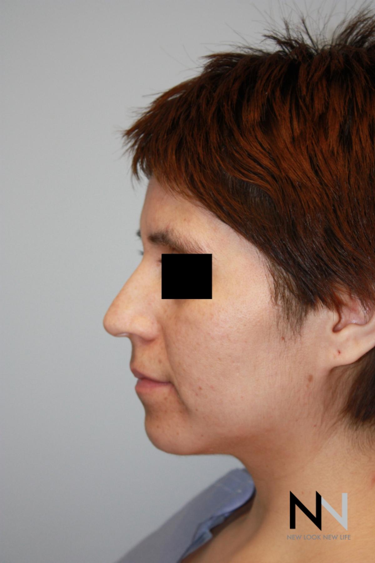 Rhinoplasty: Patient 5 - Before 2