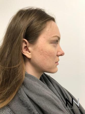 Fractional Resurfacing: Patient 4 - After Image 2