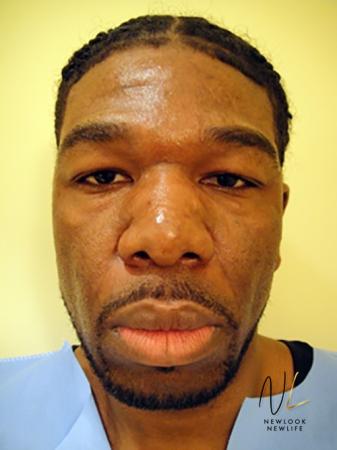 Blepharoplasty: Patient 2 - Before Image 1