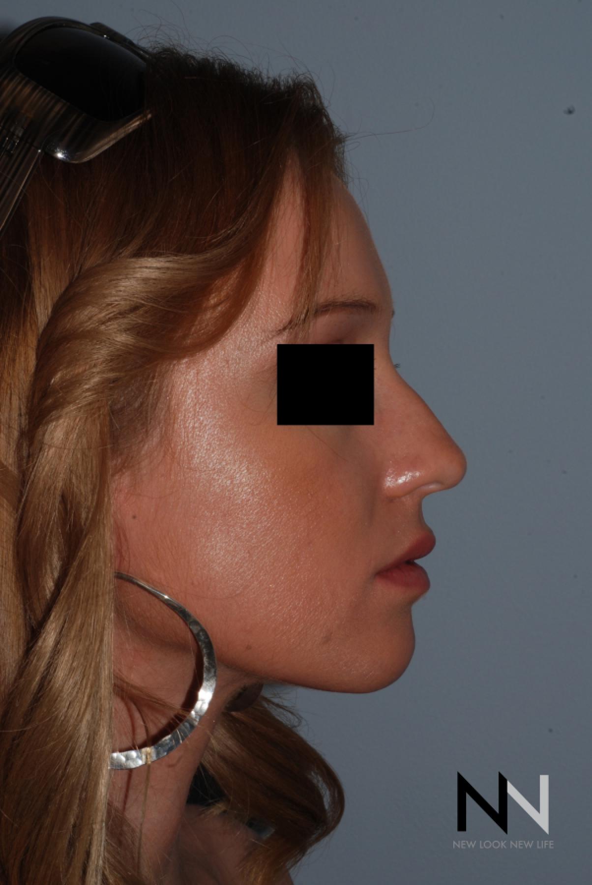 Rhinoplasty: Patient 4 - Before 