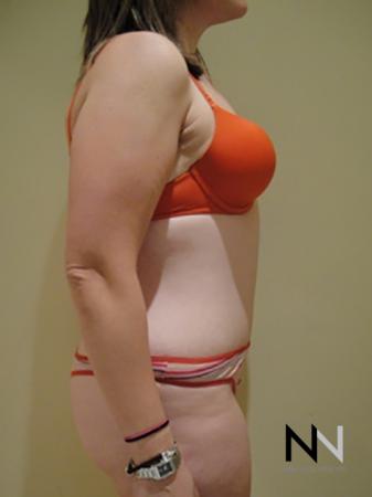 Abdominoplasty: Patient 5 - After Image 3