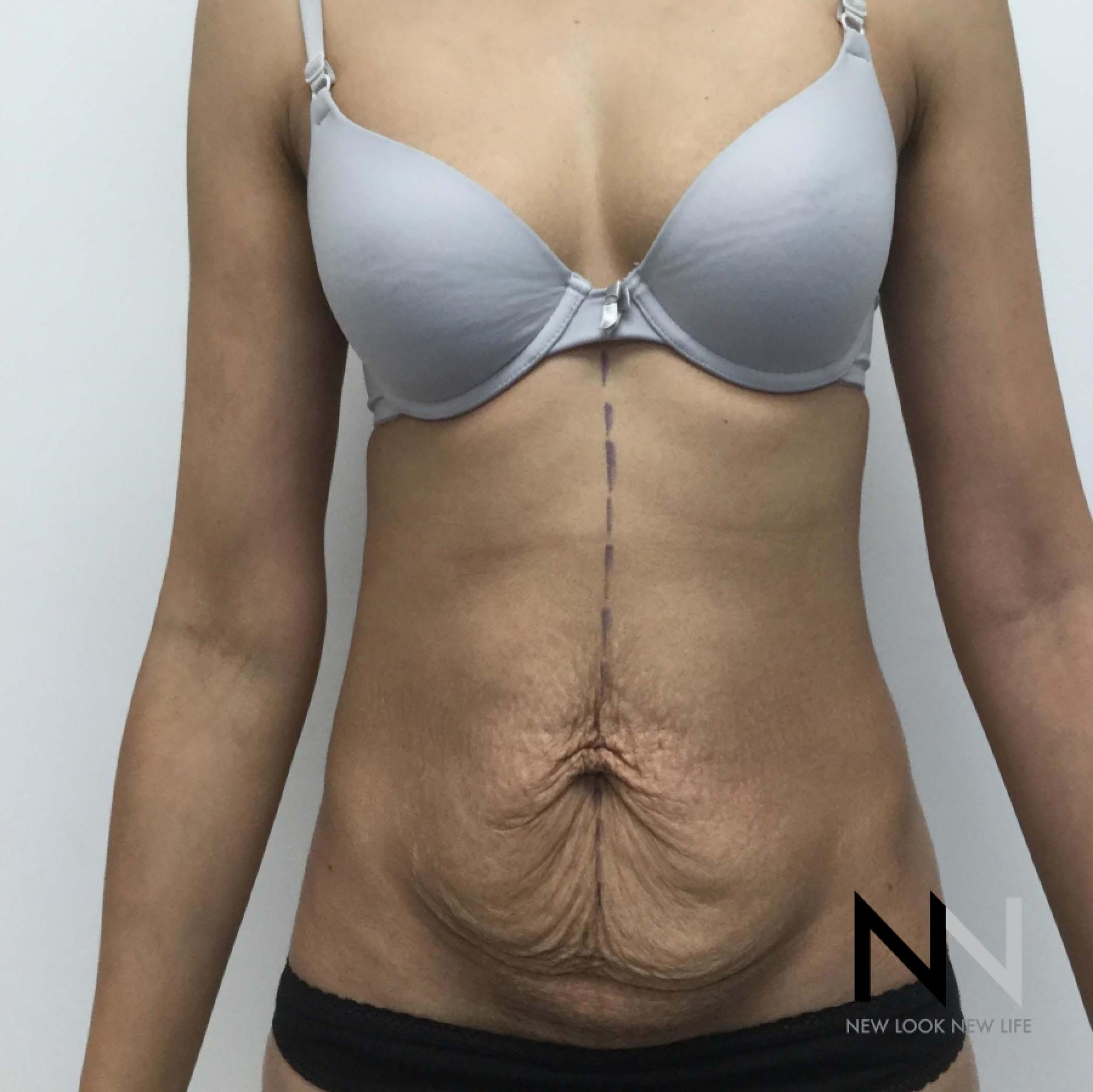 Abdominoplasty: Patient 29 - Before 1