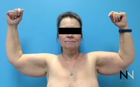 Brachioplasty: Patient 4 - Before Image 1