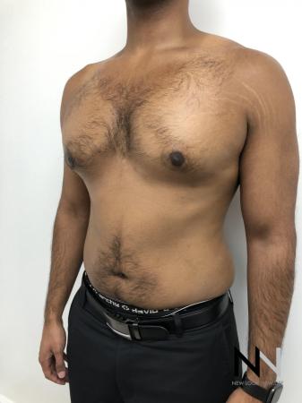 Gynecomastia: Patient 7 - After Image 3