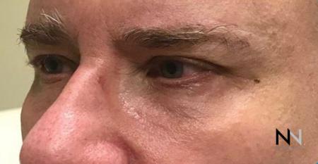 Blepharoplasty: Patient 6 - After Image 1