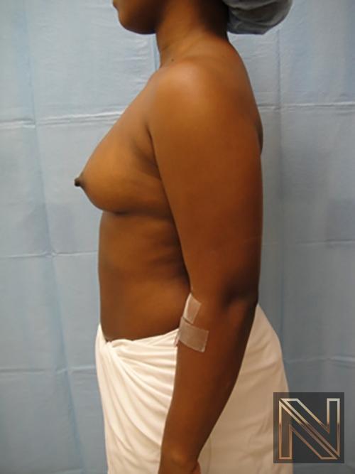 Breast Augmentation: Patient 12 - Before 4