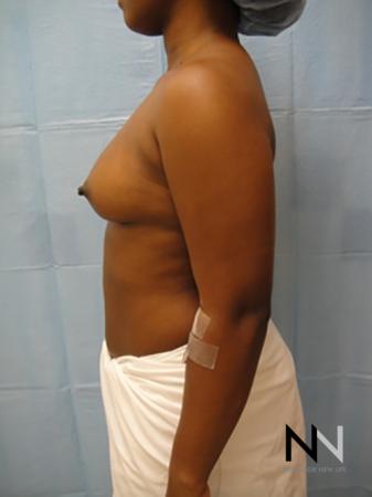 Breast Augmentation: Patient 12 - Before Image 4