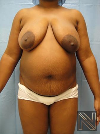 Abdominoplasty: Patient 10 - Before 1