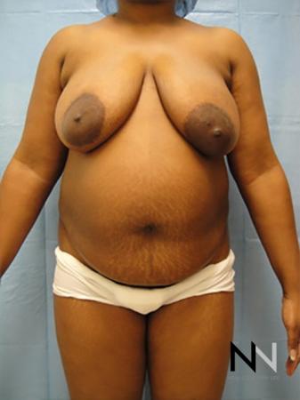 Abdominoplasty: Patient 10 - Before 1