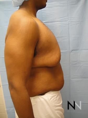 Gynecomastia: Patient 1 - Before and After Image 5
