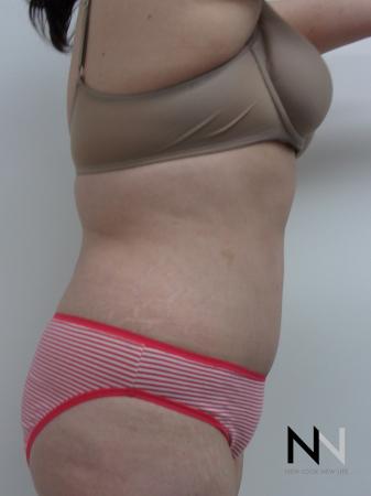 Abdominoplasty: Patient 21 - After Image 2