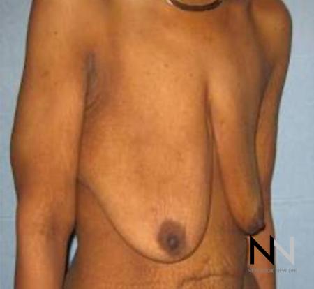 Breast Lift: Patient 13 - Before Image 2
