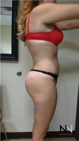 Butt Augmentation: Patient 3 - After Image 3