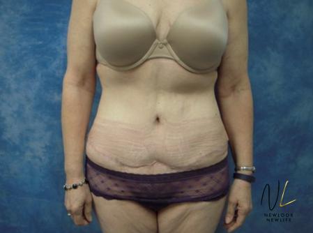 Abdominoplasty: Patient 30 - After Image 1