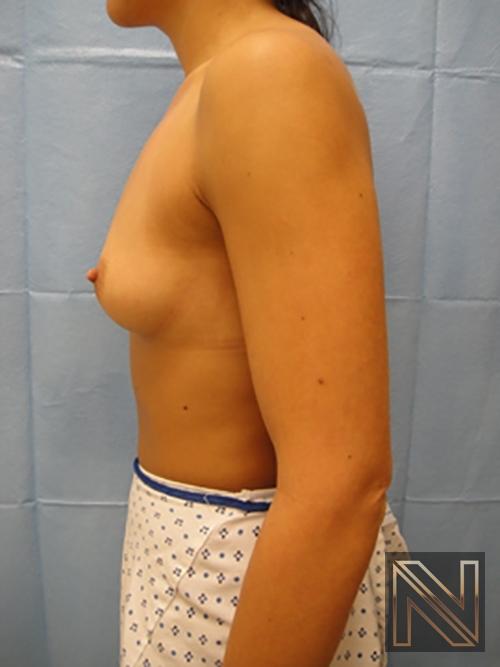 Breast Augmentation: Patient 11 - Before 4