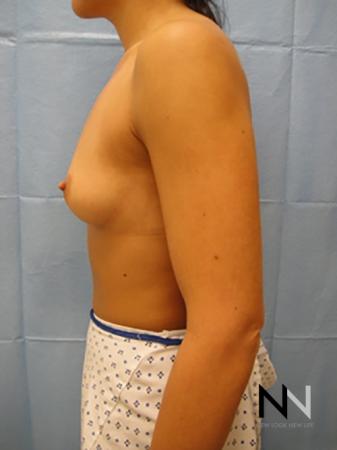 Breast Augmentation: Patient 11 - Before Image 4