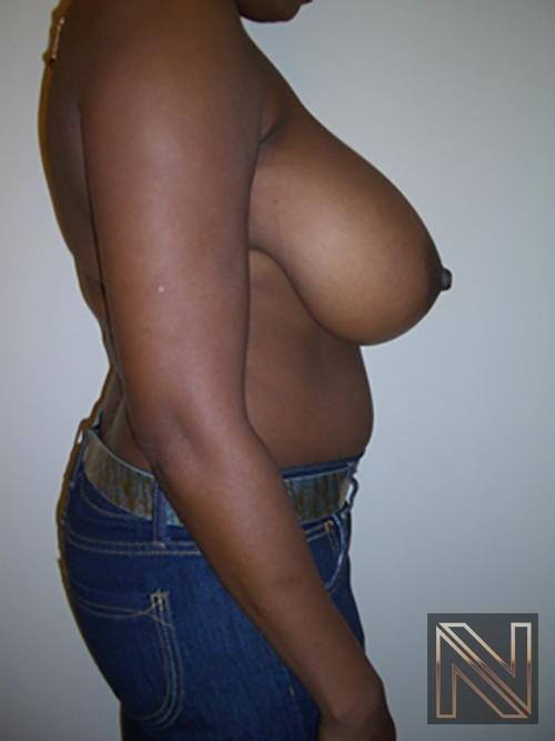 Breast Reduction: Patient 5 - Before and After 5