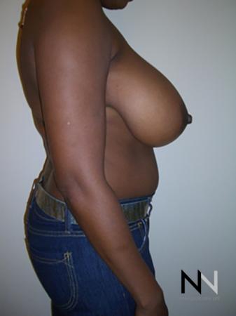 Breast Reduction: Patient 5 - Before and After Image 5