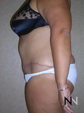 Abdominoplasty: Patient 4 - After Image 2