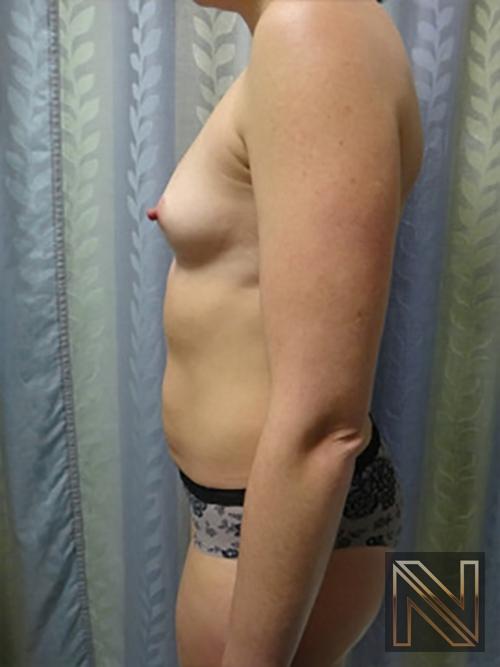 Breast Augmentation: Patient 9 - Before 4