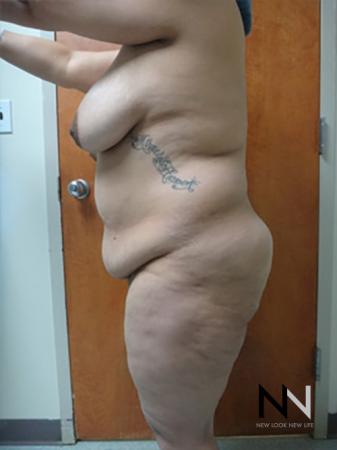 Abdominoplasty: Patient 11 - Before Image 2