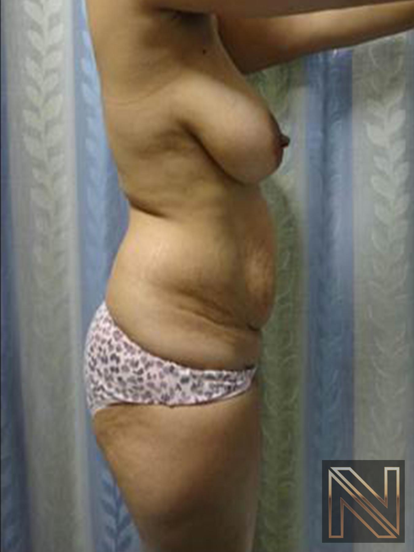 Abdominoplasty: Patient 25 - Before and After 2