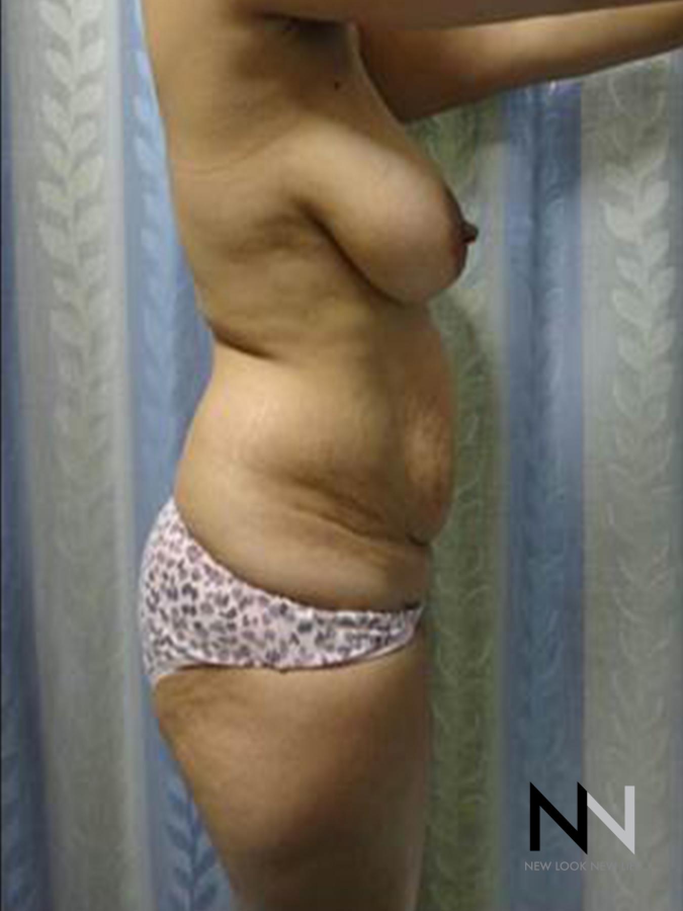 Abdominoplasty: Patient 25 - Before and After 2