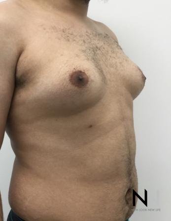Gynecomastia: Patient 10 - Before Image 4