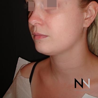 Liposuction: Patient 1 - Before Image 2