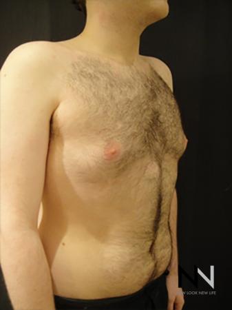 Gynecomastia: Patient 5 - After Image 3