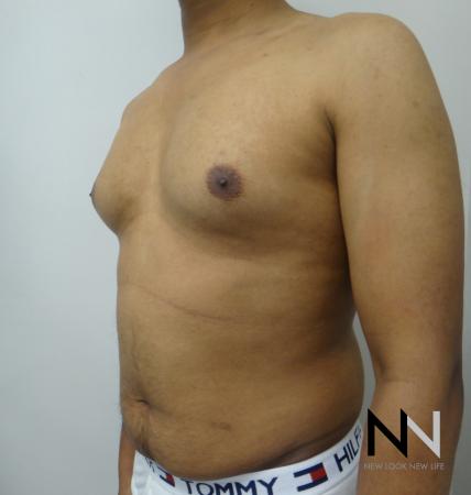 Gynecomastia: Patient 6 - Before Image 2