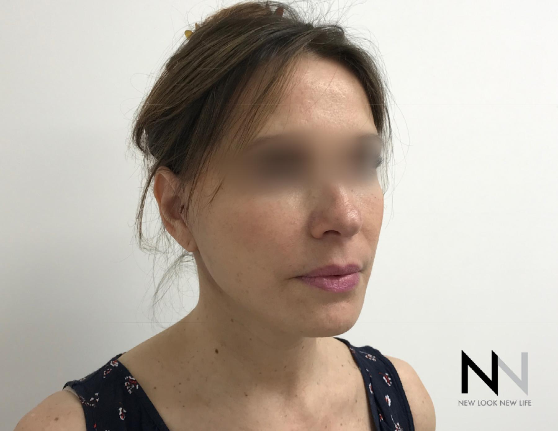 Facelift/Mini Facelift: Patient 5 - After 1